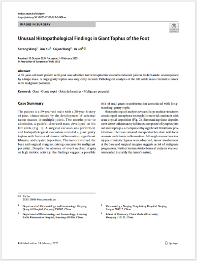2025.2ɫεȹͬ׫¡Unusual Histopathological Findings in Giant Tophus of the Foot㲿޴ʹL(fng)ʯĮMW(xu)F(xin)SCIڿIndian Journal of Surgeryl(f).png